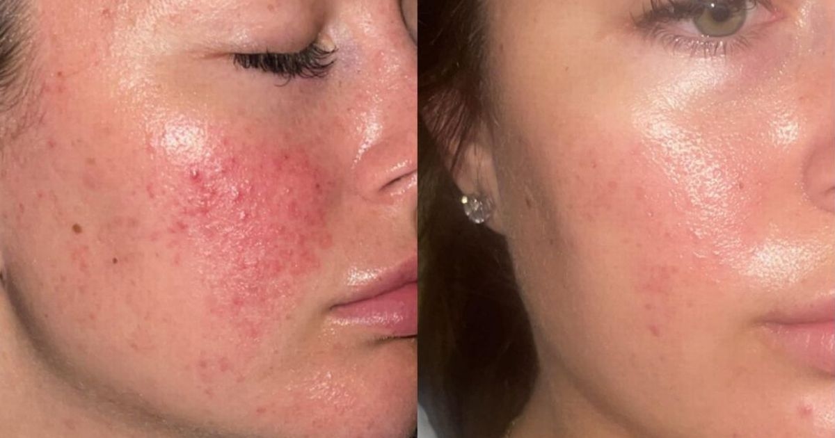 Die „lebensverändernden“ Hautpflegeprodukte von 47 Skin für zu Pickeln neigende Teenager sind jetzt 10 % günstiger