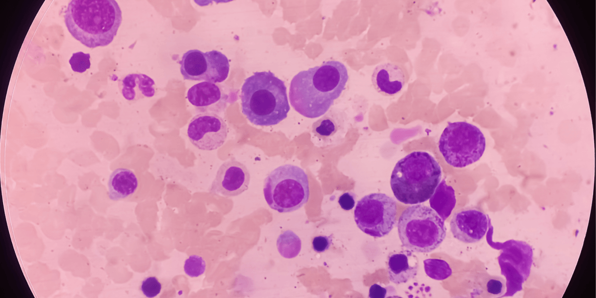 Multiple myeloma, a catastrophic disease that demands investment in innovative treatments that increase survival.