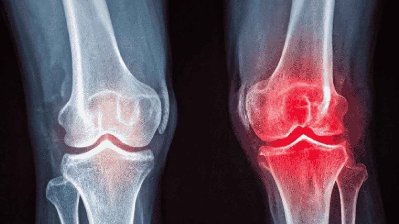 ¿Es la cirugía la última opción para la artrosis de rodilla? Terapias modernas de inyección y el papel del ejercicio.